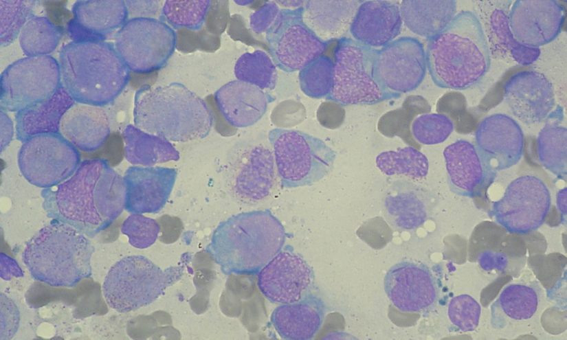 Leucemia Linfatica Cronica