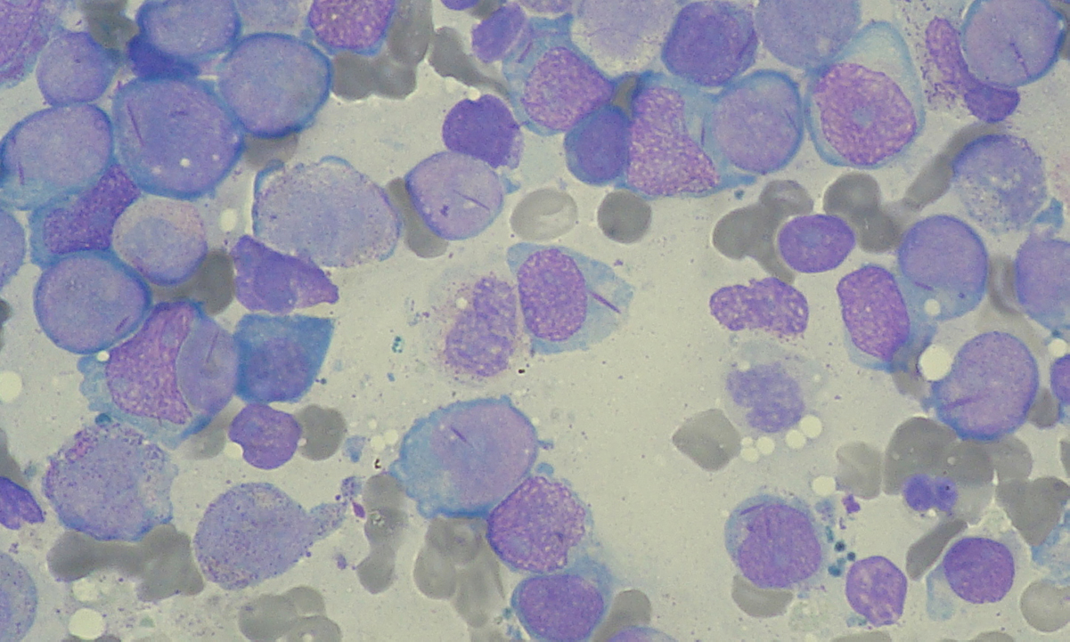 Leucemia Linfatica Cronica