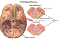 Mini cervello per la diagnosi precoce del Parkinson