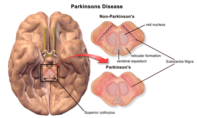 Mini cervello per la diagnosi precoce del Parkinson