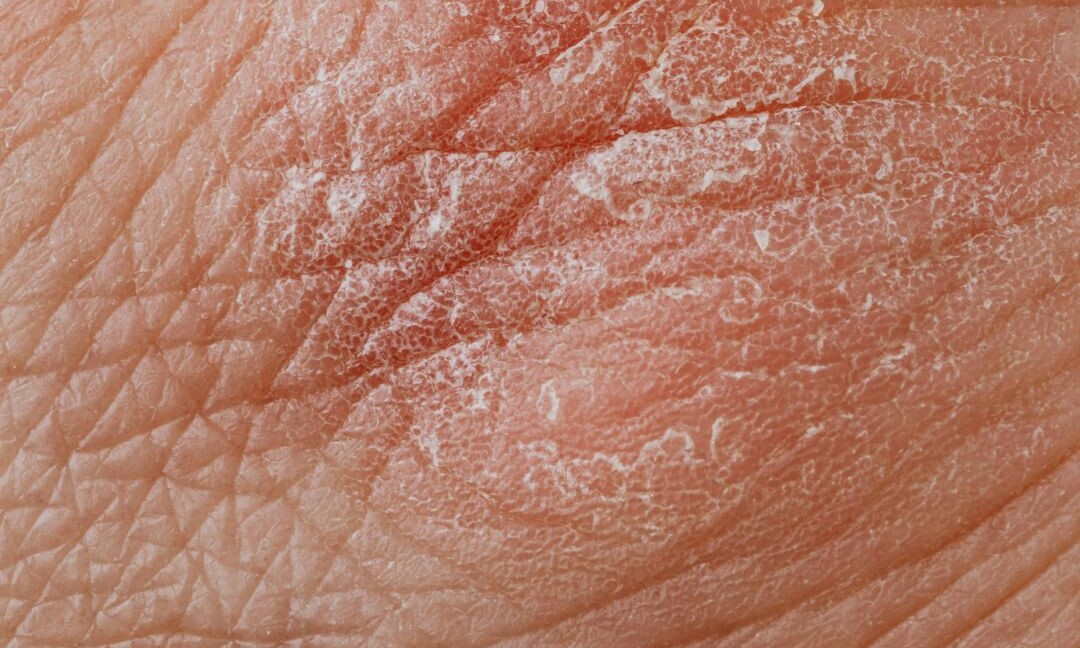 Psoriasi